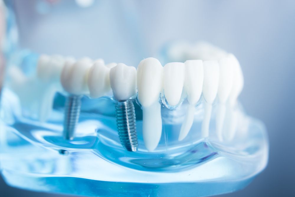 Denture Repairs Penarth & Cardiff Penarth Dental Laboratory